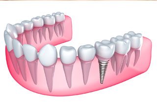 https://www.dentistasecija.es/wp-content/uploads/2015/11/cirugia-e-implantes-320x219.jpg