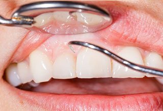 https://www.dentistasecija.es/wp-content/uploads/2015/11/periodoncia-ecija-320x219.jpg