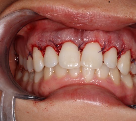 https://www.dentistasecija.es/wp-content/uploads/2017/03/ALARGAMIENTO-CORONARIO-6-540x480.jpg