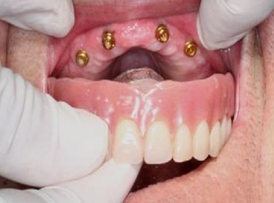 https://www.dentistasecija.es/wp-content/uploads/2017/03/SOBREDENTADURA-SUP1-1-540x400.jpg