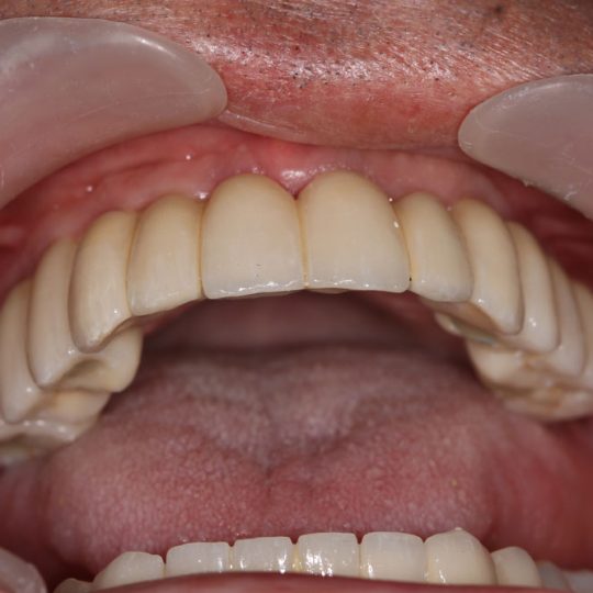 https://www.dentistasecija.es/wp-content/uploads/2017/03/implantes-dentadura-ecija-540x540.jpg