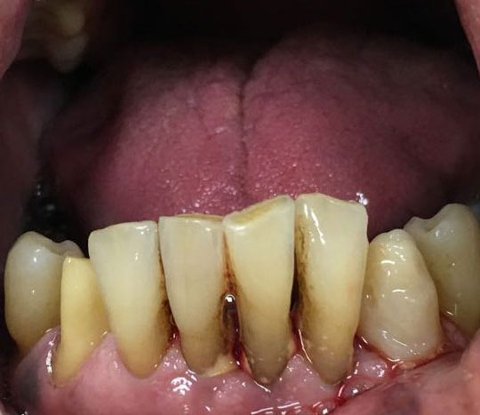 https://www.dentistasecija.es/wp-content/uploads/2017/03/provisional10-540x467.jpg